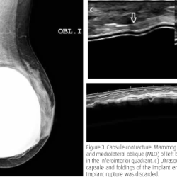 Mammography implant