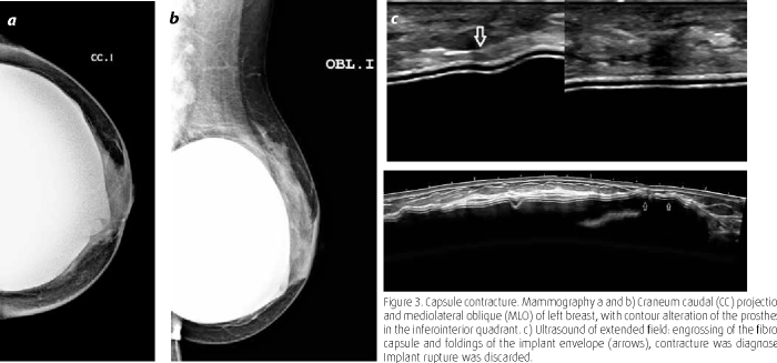 Mammography implant