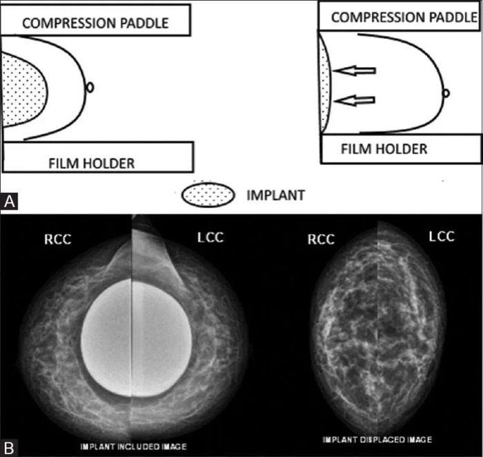 Lateral displacement breast implant displacement views